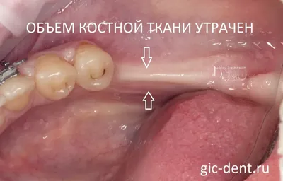 Шишка на десне: причины появления, симптомы, что если болит шарик на десне