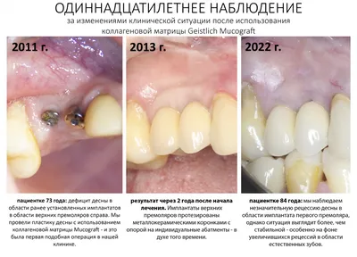 Периимплантит - лечение без удаления, симптомы и причины, фото