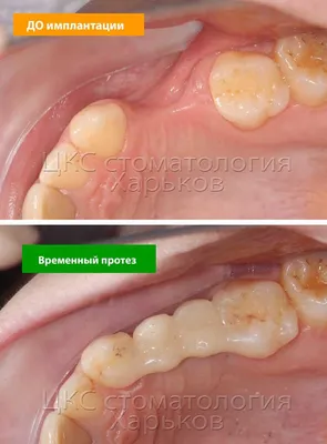 Экзостоз после удаления зуба, выпирает кость что делать?