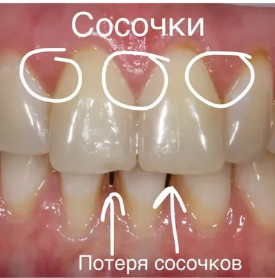 Обнажение имплантата после его установки :: Осложнения при зубной  имплантации