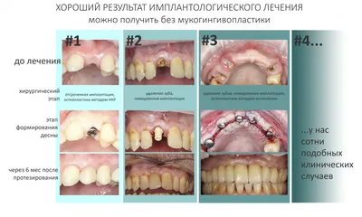 Почему натирает десна при ношении съемного протеза? | Стоматология  Королевская улыбка | Дзен