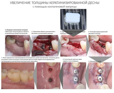 Лечение периимплантита за 8 шагов — CLINICIN.RU