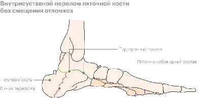 Почему после долгого ношения гипсовой повязки сложно согнуть или разогнуть  конечность? ✓ Авторские статьи Клиники подологии Полёт в Москве