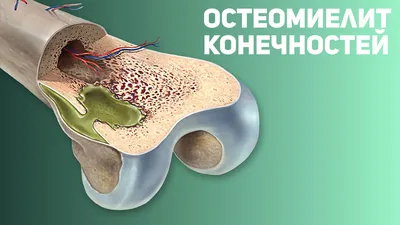 Полимерные повязки (пластиковые гипсы)