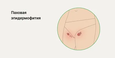 Как лечить болячки в волосах на коже головы | Блог IHC Clinic