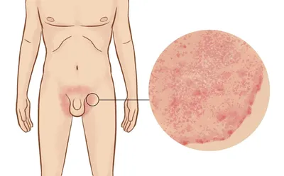 8 причин зуда в паху у мужчин: проявления на коже, лечение