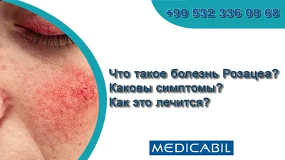 Блефарит глаз — причины, симптомы и лечение в MAJOR CLINIC