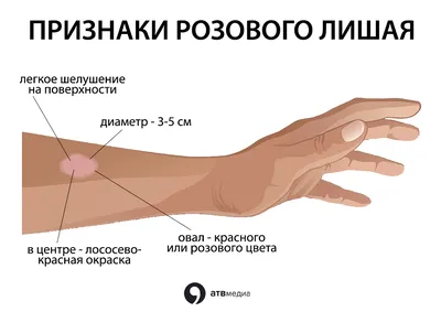 Розовый лишай (Жибера) медицинский плакат А1+, плотная фотобумага от  200г/м2 - купить с доставкой по выгодным ценам в интернет-магазине OZON  (262056336)