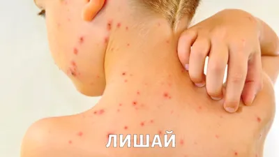 Лечение стригущего лишая (микроспория) в Киеве — Derma.ua