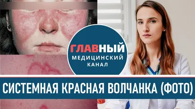 Как выглядит Красная Волчанка (фото 1-9). Симптомы системной красной  волчанки. Болезнь Либмана-Сакса - YouTube