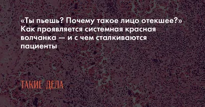 Особенности системной красной волчанки у мужчин: описание случаев и данные  литературы – тема научной статьи по клинической медицине читайте бесплатно  текст научно-исследовательской работы в электронной библиотеке КиберЛенинка