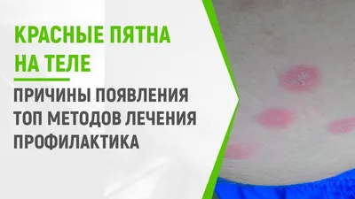 Дополнение к вопросу Что за красные пятна на ноге? Что за красные пятна |  MedAboutMe