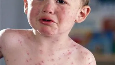 Детские инфекции: краснуха – в чем ее причины, как проявляется и как ее  нужно лечить | О детском здоровье: с врачебного на родительский | Дзен