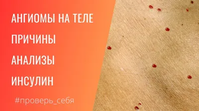 Какие признаки на коже сигнализируют о слишком густой крови: 18 августа  2022, 10:01 - новости на Tengrinews.kz