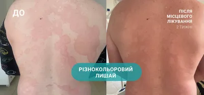 Красный плоский лишай