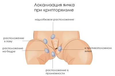 Крипторхизм у детей — лечение бесплатно по ОМС