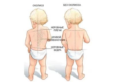 Сколиоз у детей: симптомы, диагностика, лечение