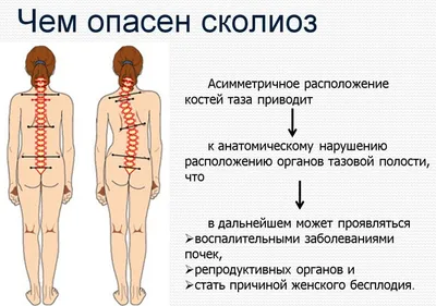 Защемление седалищного нерва: симптомы, причины, как снять воспаление,  лечение