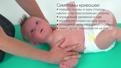 Кривошея у детей. Остеопатическое лечение 0+