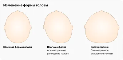 У ребенка голова повернута на одну сторону: что такое кривошея и чем она  опасна для малыша | О детском здоровье: с врачебного на родительский | Дзен