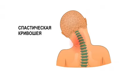 В этом году ко мне обратилась мама ребёнка с нарушениями по ОДА. Анамнез,  со слов мамы. Спастическая кривошея В 2 месяца были у… | Instagram