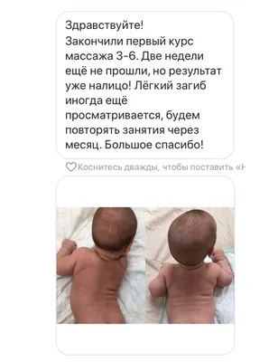 Может ли остеопат скорректировать кривошею?