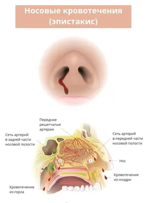 Носовое кровотечение у ребенка: причины, первая помощь, методы лечения.
