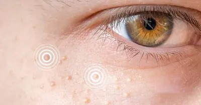 Xanthelasma: Causes, Symptoms, and Treatment