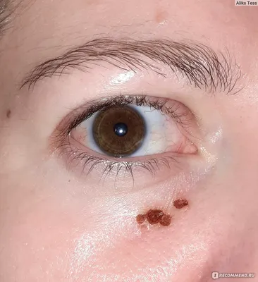 https://www.instagram.com/dermatolog_kassimov/p/CjZ8Rq1Dkj9/