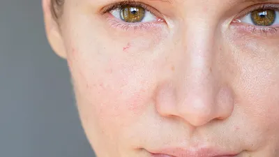 Купероз на лице: причины, симптомы, лечение, профилактика в домашних  условиях