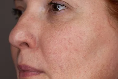 Уход за кожей с куперозом: что делать и как лечить