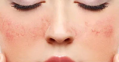 Marina_cosmetolog_dnepr - Купероз❗️ Купероз на лице – это косметический  дефект, который появляется из-за расширенных кровеносных сосудов. Они  просвечиваются сквозь кожу и имеют вид «звездочек» или «паутинки» из  капилляров. Чаще всего купероз встречается