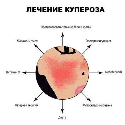 Купероз - причины появления, при каких заболеваниях возникает, диагностика  и способы лечения