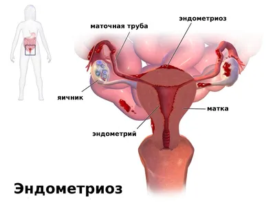 Месячные со сгустками, похожими на печень: причины и методы лечения