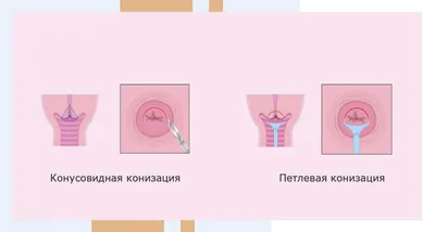 Кольпоскопия анализ и обследование шейки матки в Новороссийске - клиника МХК