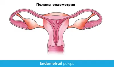 ЭНДОМЕТРИОЗ - ЛЕЧЕНИЕ В ЯПОНИИ