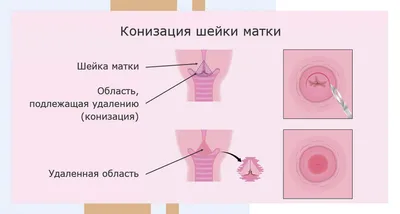 Биопсия шейки матки в Симферополе: показания, противопоказания