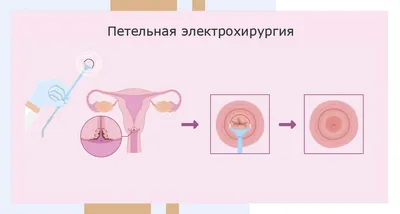 Коричневые выделения у женщин - причины, симптомы и лечение