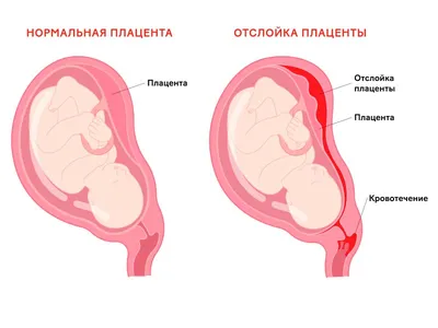 Сгустки крови при месячных — норма... - Libresse Kyrgyzstan | Facebook