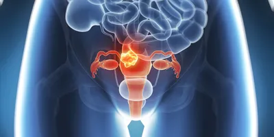 Менструальные капы Aliexpress Medical Grade Silicone Menstrual Cup - «НЕ  рекомендую для молодых девушек и малоактивных женщин! Всем остальным тоже  есть над чем задуматься... Очень много минусов...» | отзывы