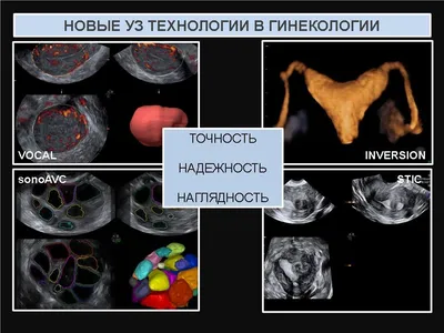 Эндометриоз послеоперационного рубца: особенности клинического течения,  диагностики, лечения и результатов морфологического исследования  операционного материала - Печеникова - Журнал акушерства и женских болезней