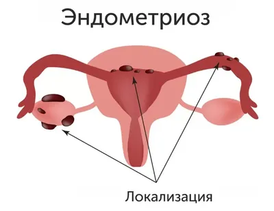 Диета при эндометриозе - «Очень личная история про самую загадочную женскую  болезнь и действенный способ облегчить страдания» | отзывы