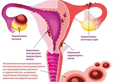 Эндометриоз - диагностика и лечение, причины, симптомы | Клиника «Геном» в  Ростове-на-Дону