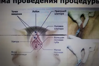 Лабиопластика Киев — цены на пластику половых губ, отзывы о хирургах