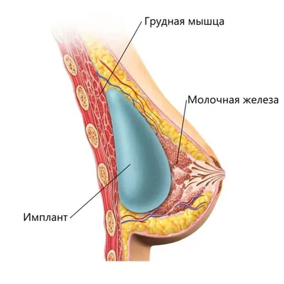 Пластика тубулярной груди - возможна ли маммопластика при тубулярности  груди?