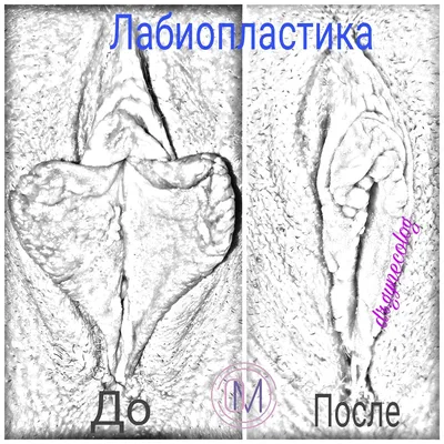 Лабиопластика — Москва