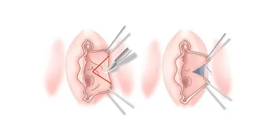 ▷Лабиопластика в Киеве – Интимна пластика половых губ ✓ Цены в МЦ ADONIS