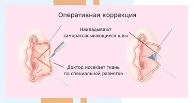 Lapino - 🌺 Лабиопластика - плюсы, минусы и показания к процедуре 👇🏻 ⠀ ➡️  Лабиопластика – пластическая операция, выполняемая на половых губах.  Процедура позволяет корректировать их форму и размер. ⠀  #лапино_интимная_реабилитация ⠀