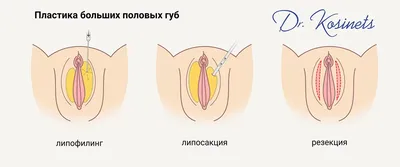 Лабиопластика – пластика половых губ