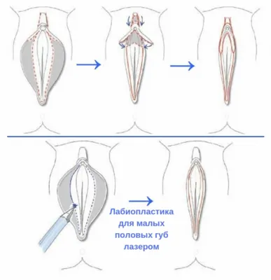 Пластика половых губ (лабиопластика) в Минске - цена уменьшения малых  половых губ